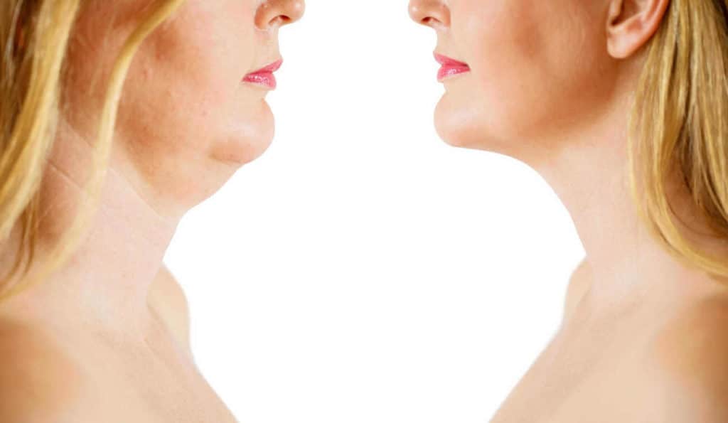 Double Chin treatment Waltham Abbey before and after results
