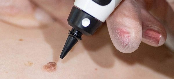 After Skin Tag Removal Waltham Abbey