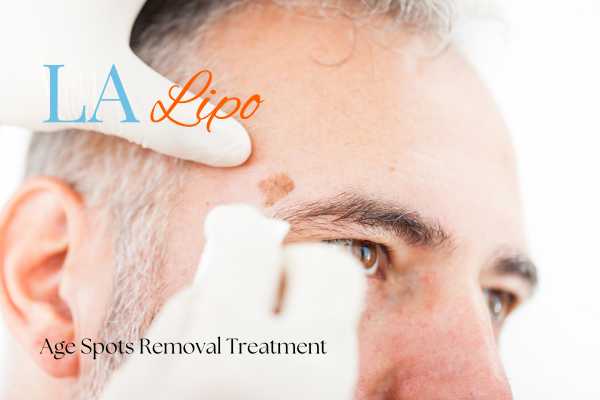What Are the Most Effective Treatments for Age Spots Waltham Abbey?