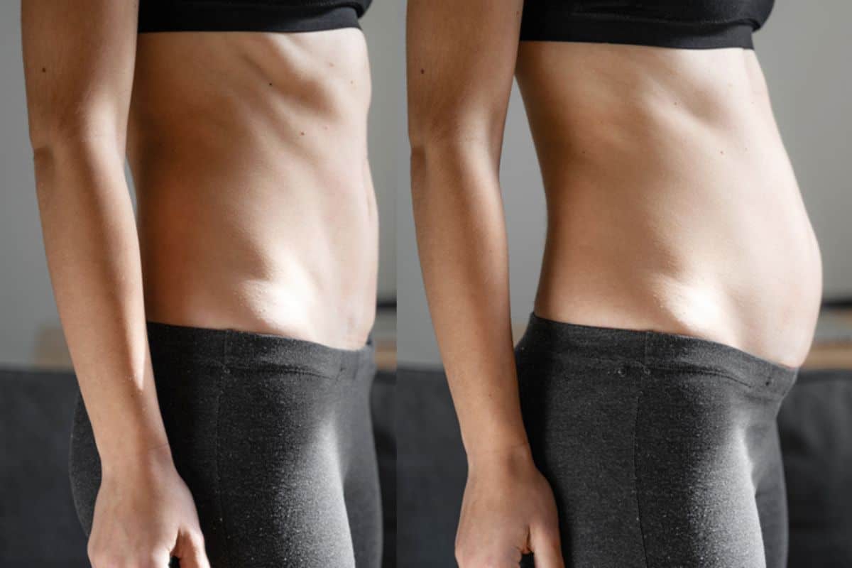 How long does diastasis recti take to improve Waltham Abbey?