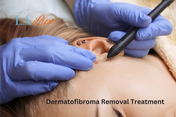 Dermatofibroma Removal Treatment Waltham Abbey