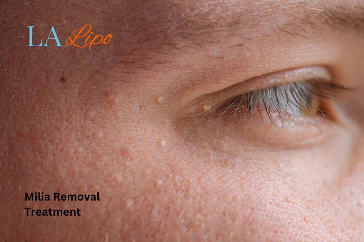 Cryopen Milia Removal: Is It the Easiest and Safest Option Waltham Abbey?
