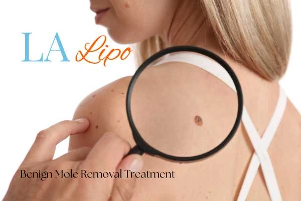 Woman having her inspection of blemish before mole removal Waltham Abbey