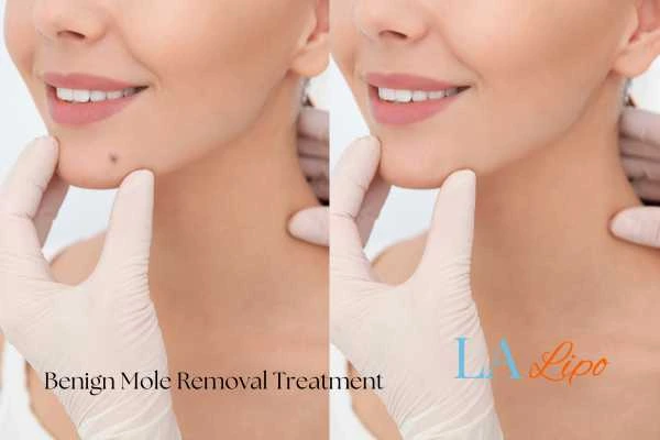 Before and after mole removal Waltham Abbey treatment