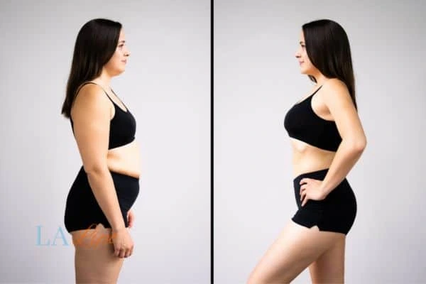 LA-EMS Body Sculpting Waltham Abbey results before and after of womans results on body toning.