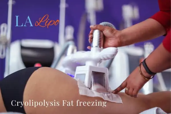women getting fat freezing Waltham Abbey