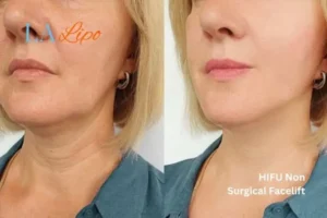 hi-fu for wrinkles Waltham Abbey before and after results