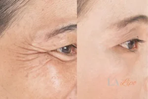 Before and after results of woman - HI-fu wrinkles reduction treatment Waltham Abbey