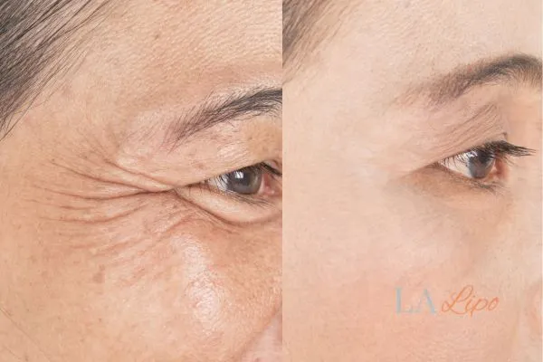 Before and after results of woman - HI-fu wrinkles reduction treatment Waltham Abbey