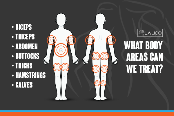 Graphic to show areas you can have LA-EMS Body Sculpting Waltham Abbey treatment.