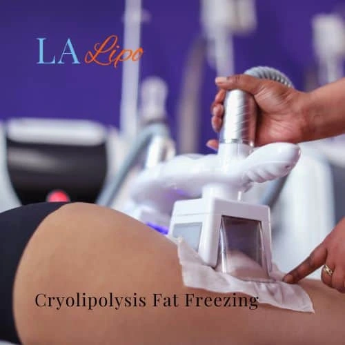 fat freezing - Cryolipolysis Waltham Abbey