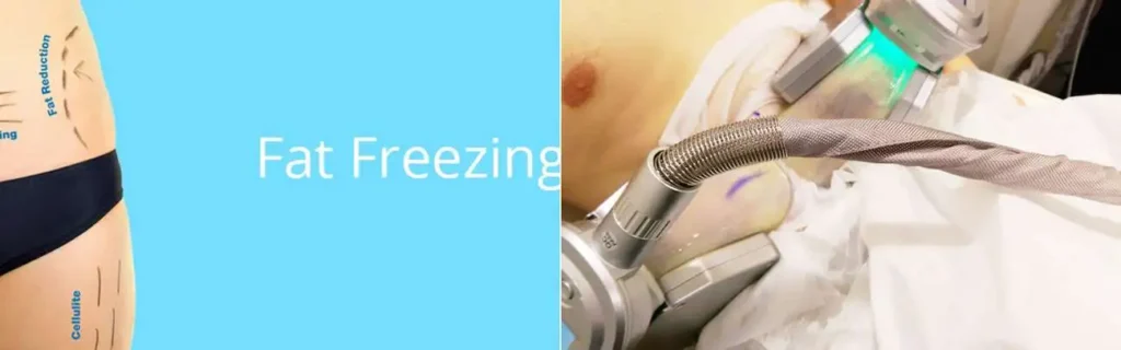 Fat freezing Waltham Abbey on multiple areas of the body
