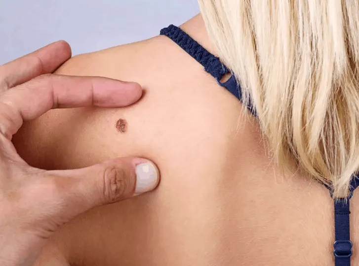 woman having mole removal Waltham Abbey consultation before treatment.