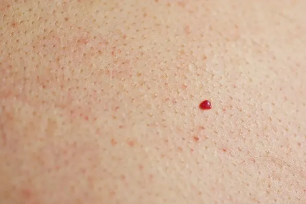 close up of a cherry angioma Waltham Abbey
