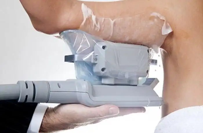 Picture of fat freezing Waltham Abbey on the upper arms.
