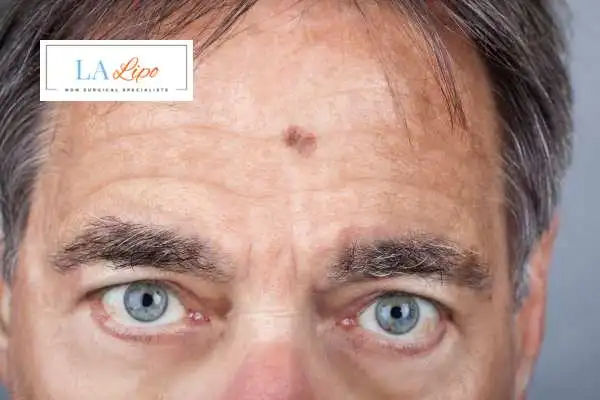 Solar Lentigo Removal Waltham Abbey image of man with mark on his forehead