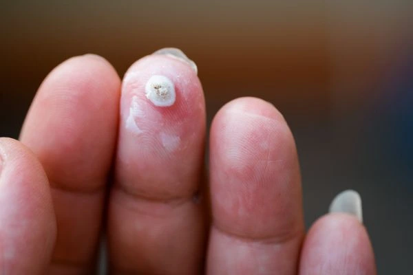 wart on person finger - cryotherapy to treat from LA LIPO Waltham Abbey