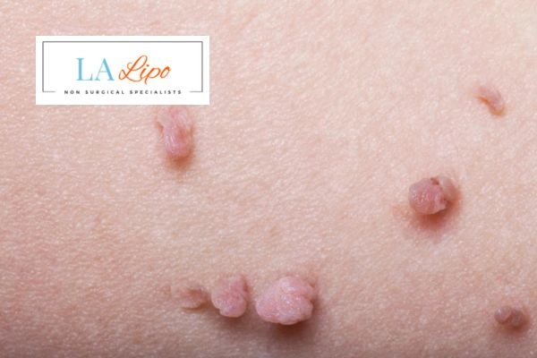 Does cryopen skin tag removal Waltham Abbey hurt? Find out now call our team today!