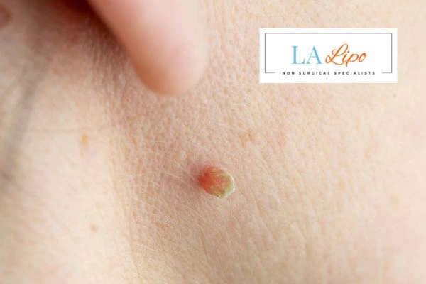 Book skin tag removal Waltham Abbey today speak to our team now!