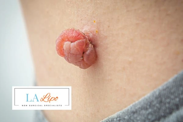 Interested in skin tag removal Waltham Abbey? Concerned about the pain? Find out more today!