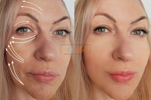 Morpheus 8 results Waltham Abbey face lift.