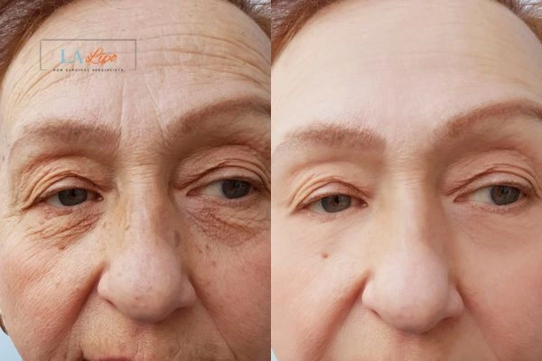 The powerful benefits of Morpheus8 Treatment Waltham Abbey - Call Our team today!