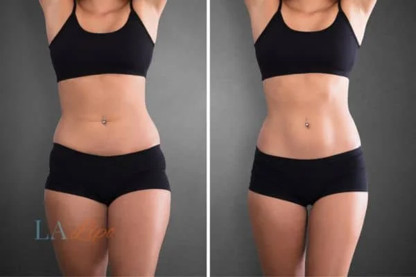 before and after results of non-surgical treatment to help a woman's body image and mental health Waltham Abbey
