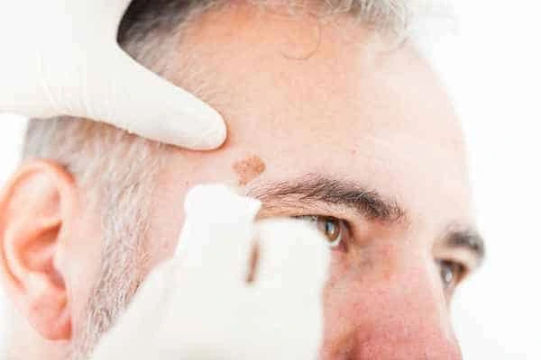 Age spots and elderly people Waltham Abbey what is the link?