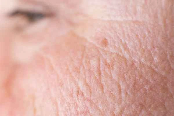 close up picture of a woman's face showing an age spot Waltham Abbey
