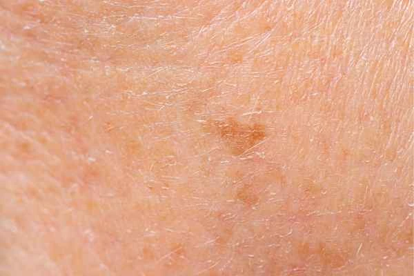 close up picture of age spots Waltham Abbey
