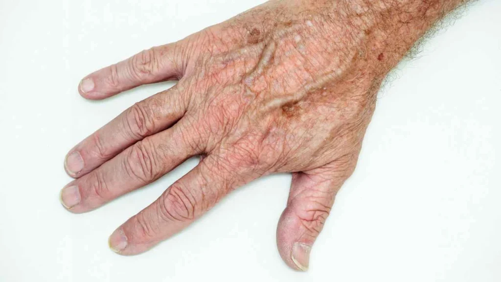 Male hand showing age spot Waltham Abbey