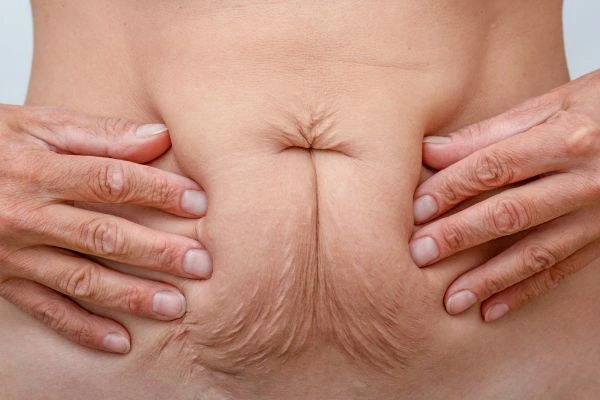 Image of a woman's stomach with loose skin - example of skin tightening Waltham Abbey options