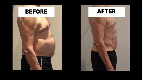 What Symptoms Can Diastasis Recti Cause in Men? Weak Core, Back Pain and Poor Posture Waltham Abbey